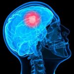 Brain-cancer
